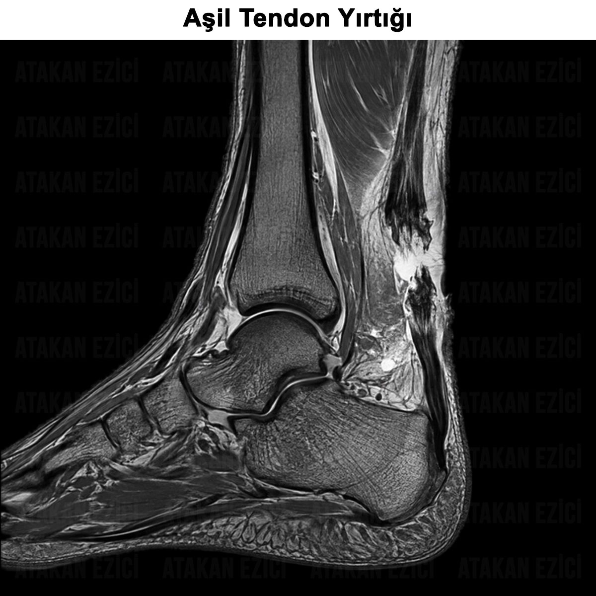 Aşil Tendon Yırtığı