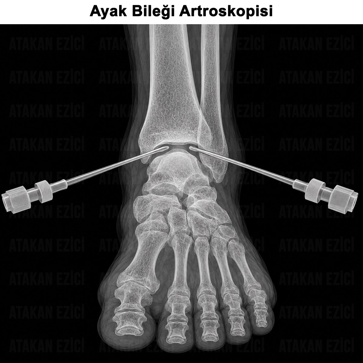 Ayak Bileği Artroskopisi: Nasıl Yapılır? Kullanım Alanları?