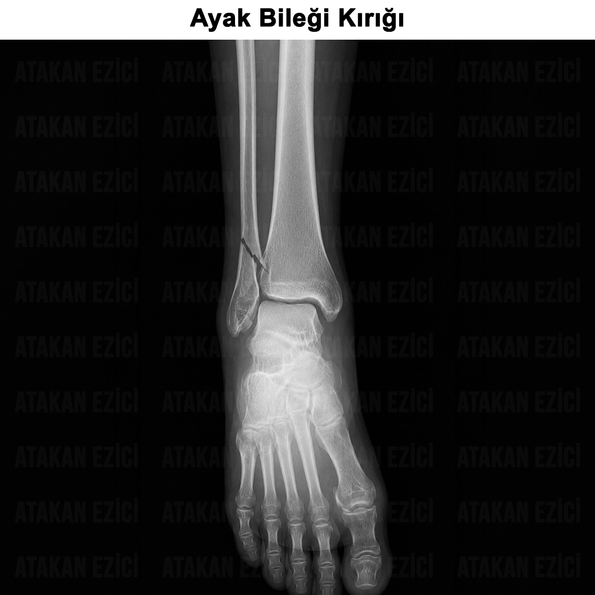 Ayak Bileği Kırığı: Nedir? Tanısı, Tedavisi ve Ameliyatı