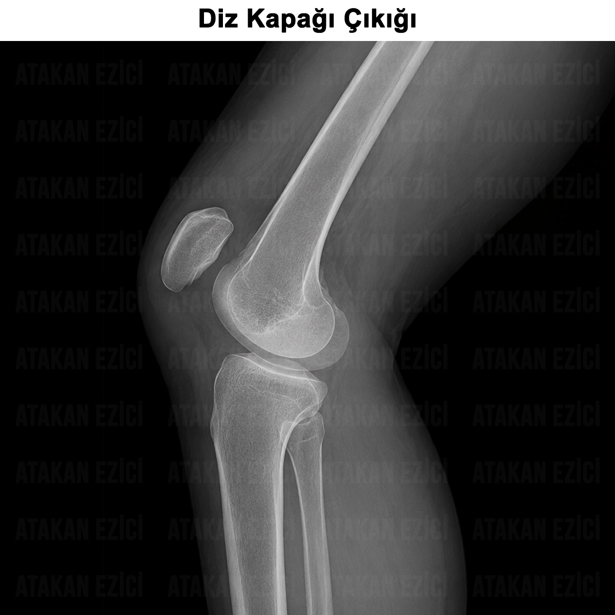 Diz Kapağı Çıkığı Nedir? Tanısı, Nedenleri ve Ameliyatı