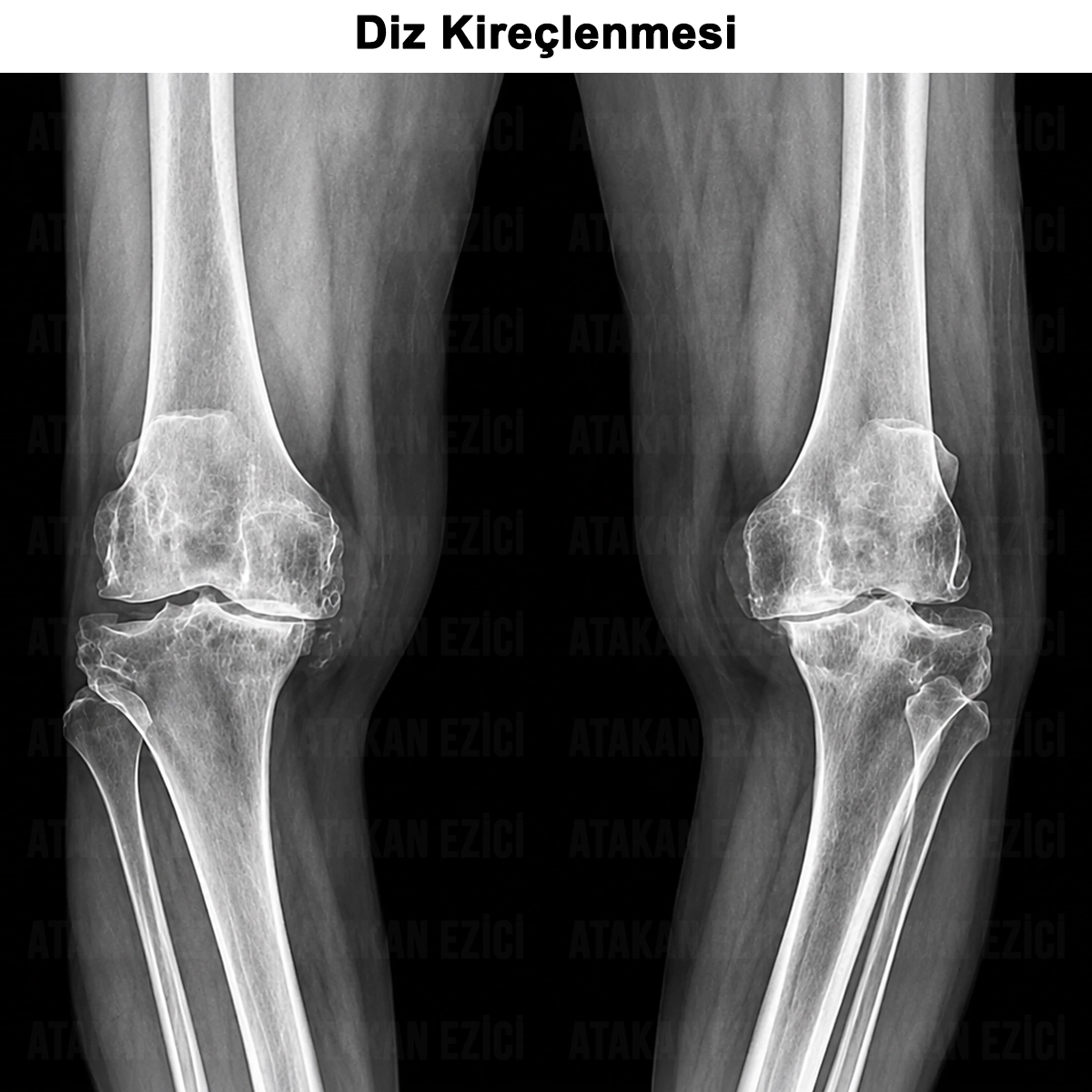 Diz Kireçlenmesi (Gonartroz): Nedir? Nedenleri? Tedavisi?