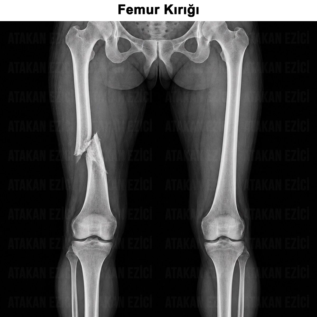 Femur Kırığı Nedir? Yaşa Özgü Tanısı, Tedavisi ve Ameliyatı