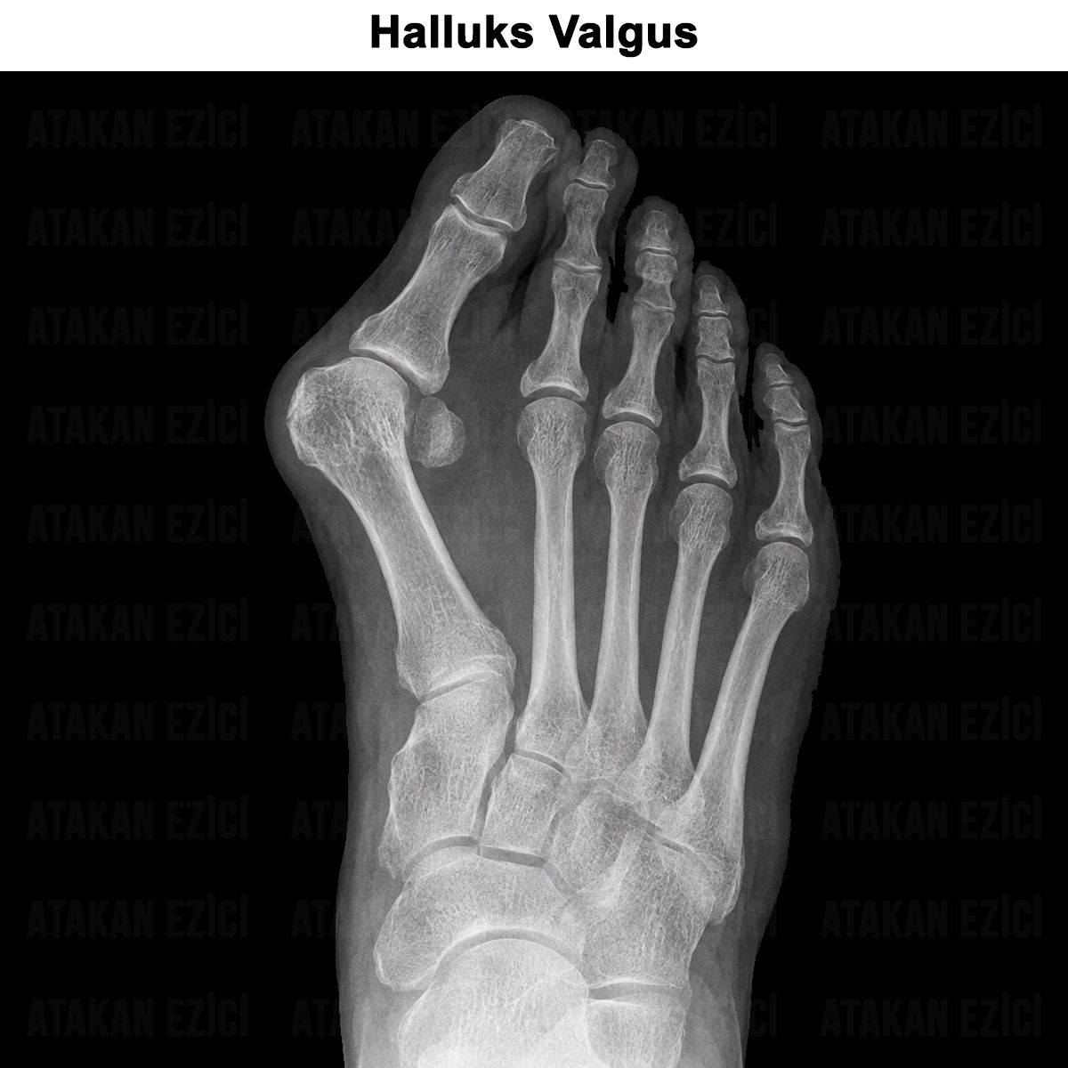 Halluks Valgus (Başparmak Eğriliği): Tedavisi ve Ameliyatı