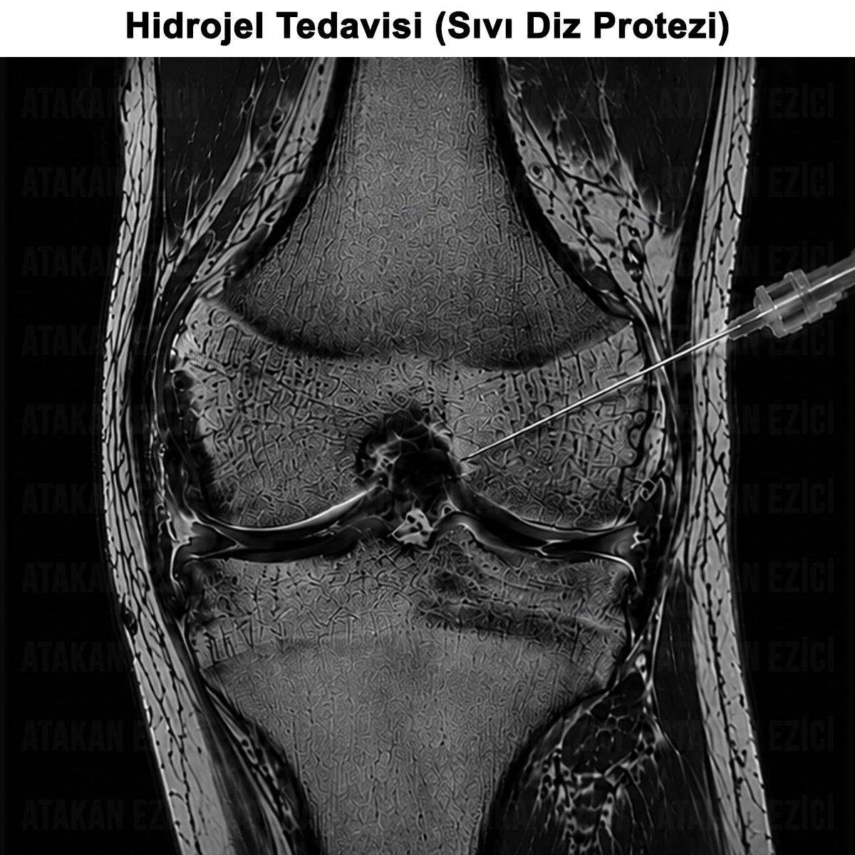 Hidrojel Tedavisi: Nedir? Nasıl ve Kimlere Uygulanır?