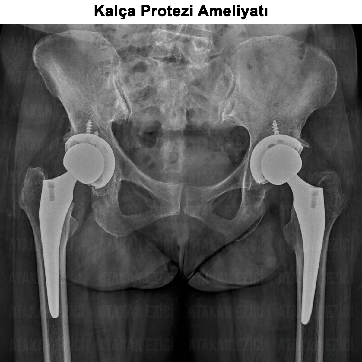 Kalça Protezi Ameliyatı