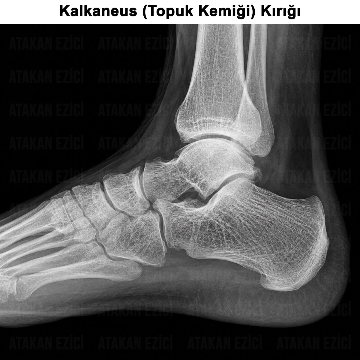 Kalkaneus (Topuk Kemiği) Kırığı: Nedir? Tanısı ve Tedavisi