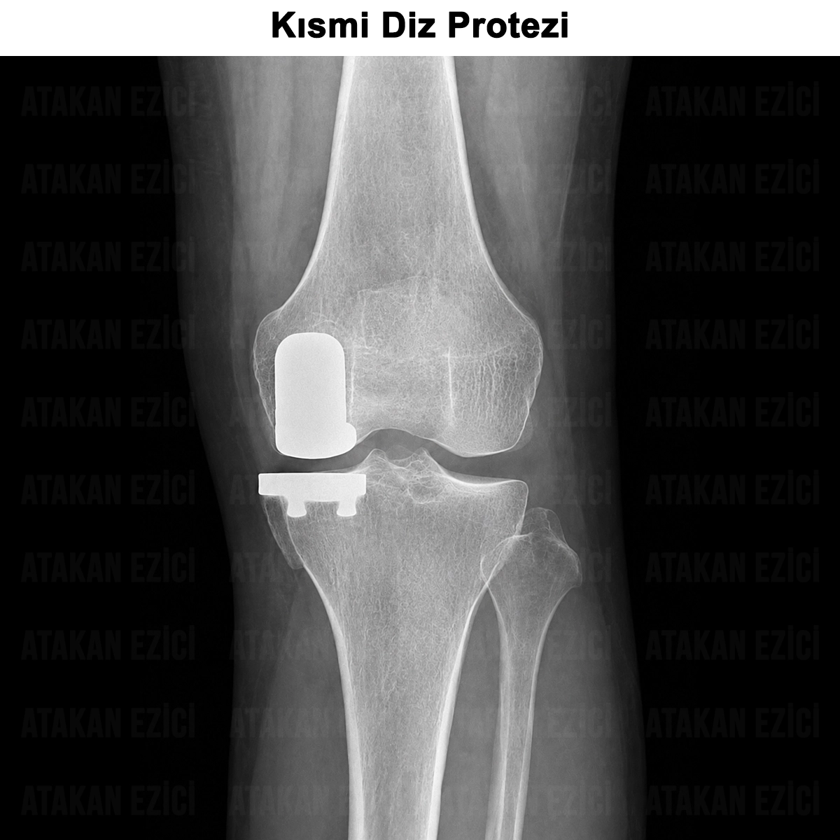 Kısmi Diz Protezi: Nedir? Avantajları ve Ameliyatı