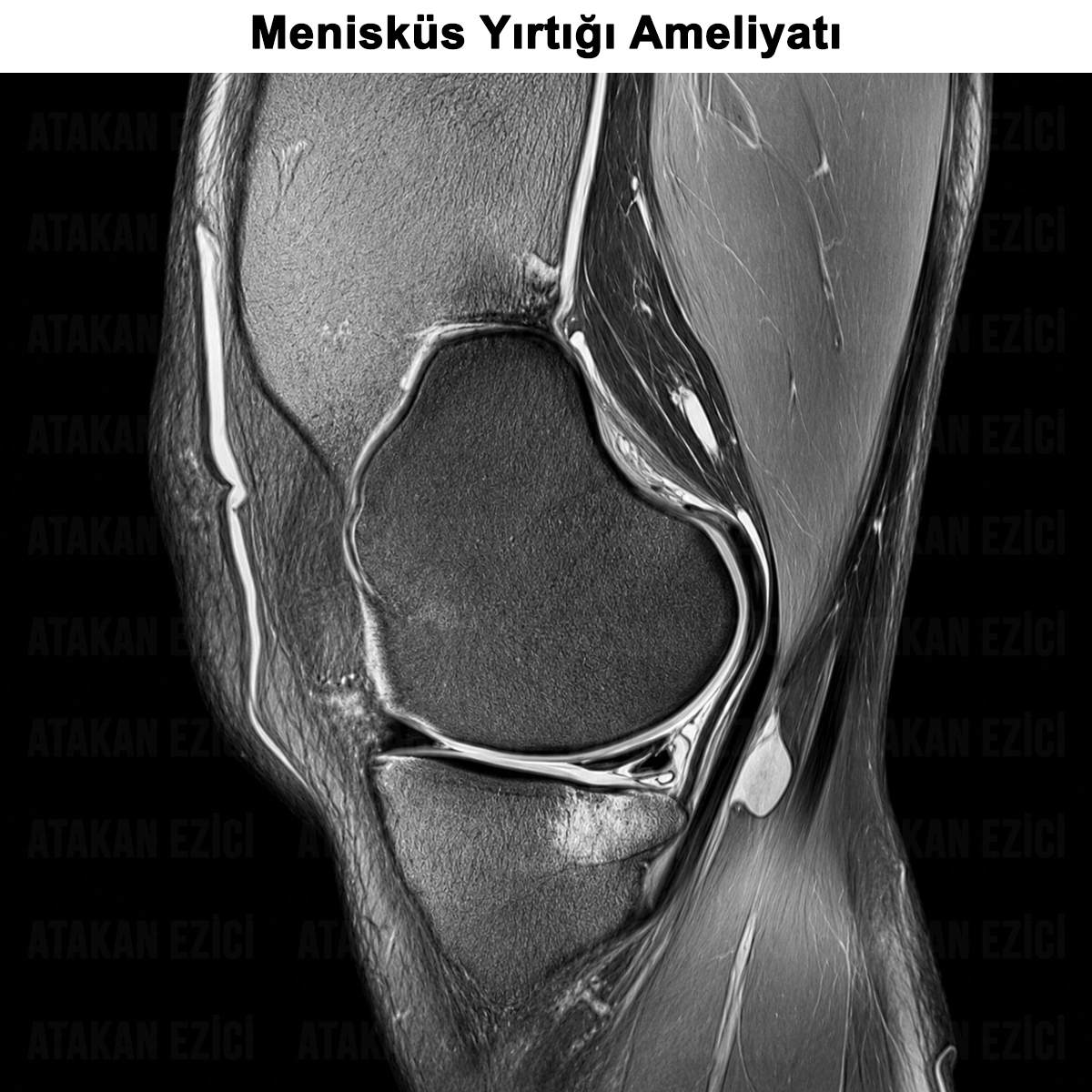 Menisküs Ameliyatı: Nedir? Nasıl Yapılır? Sonrası?
