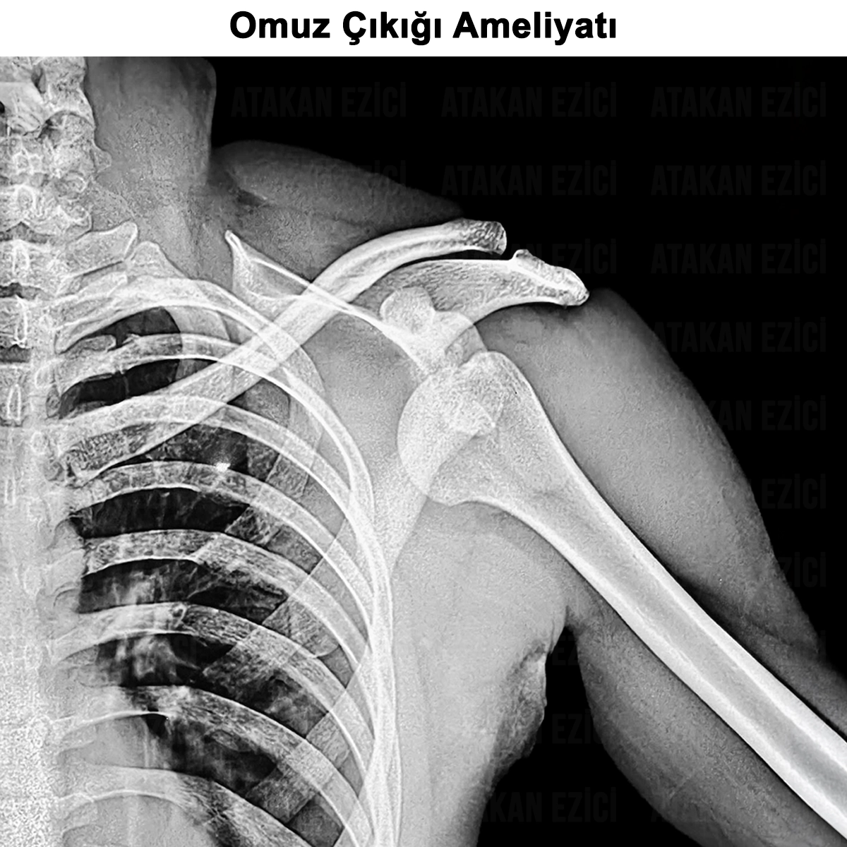 Omuz Çıkığı: Nedenleri? Tanısı? Tedavisi ve Ameliyatı