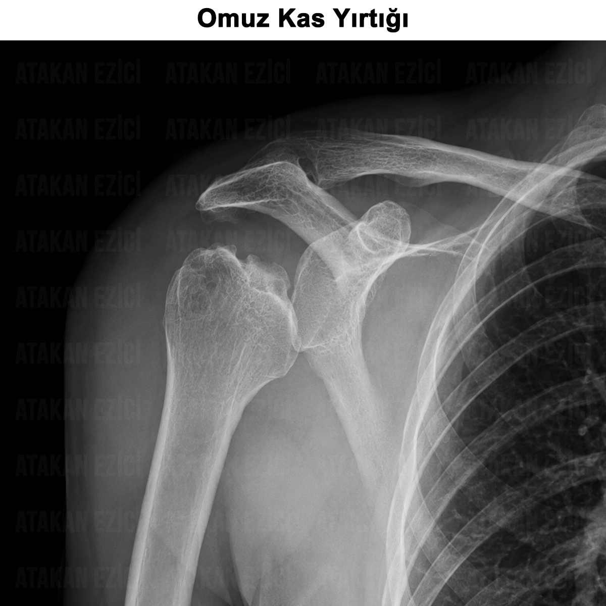 Omuz Kas Yırtığı: Nedir? Tedavisi, Egzersizleri, Ameliyatı