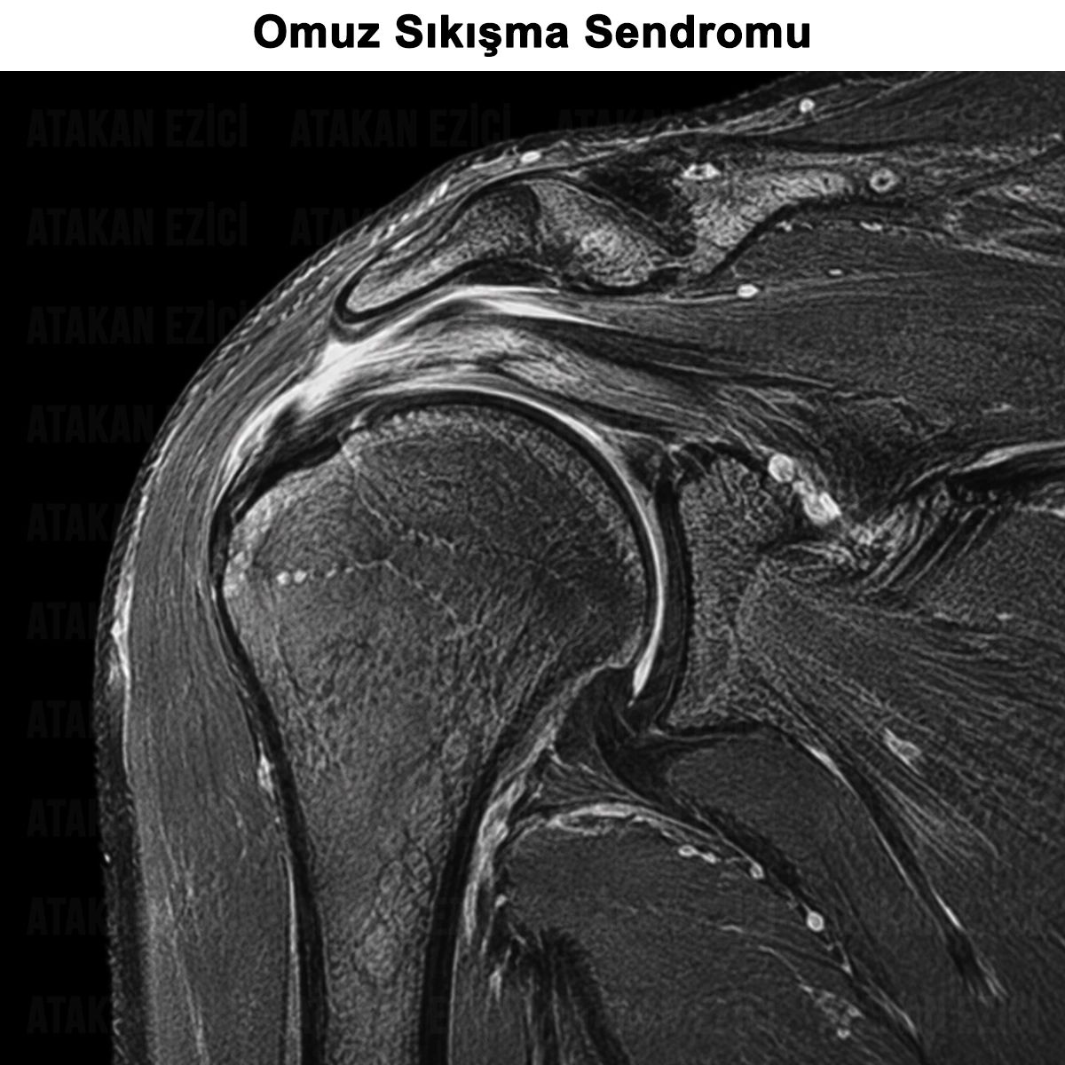 Omuz Sıkışma Sendromu: Nedenleri, Tedavisi ve Ameliyatı