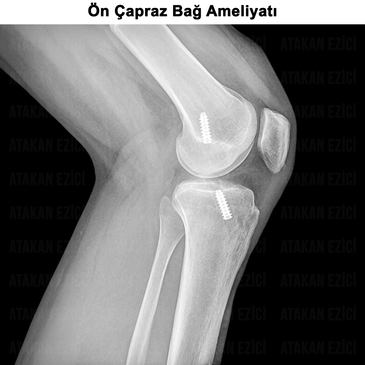 Ön Çapraz Bağ Ameliyatı: Ne Zaman Gerekir? Greftler?