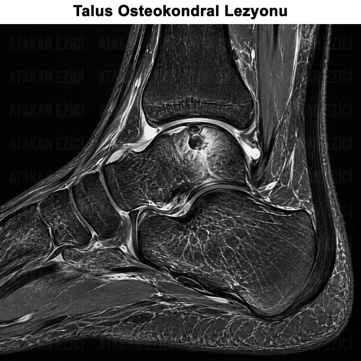 Talus Osteokondral Lezyonu (OCD):