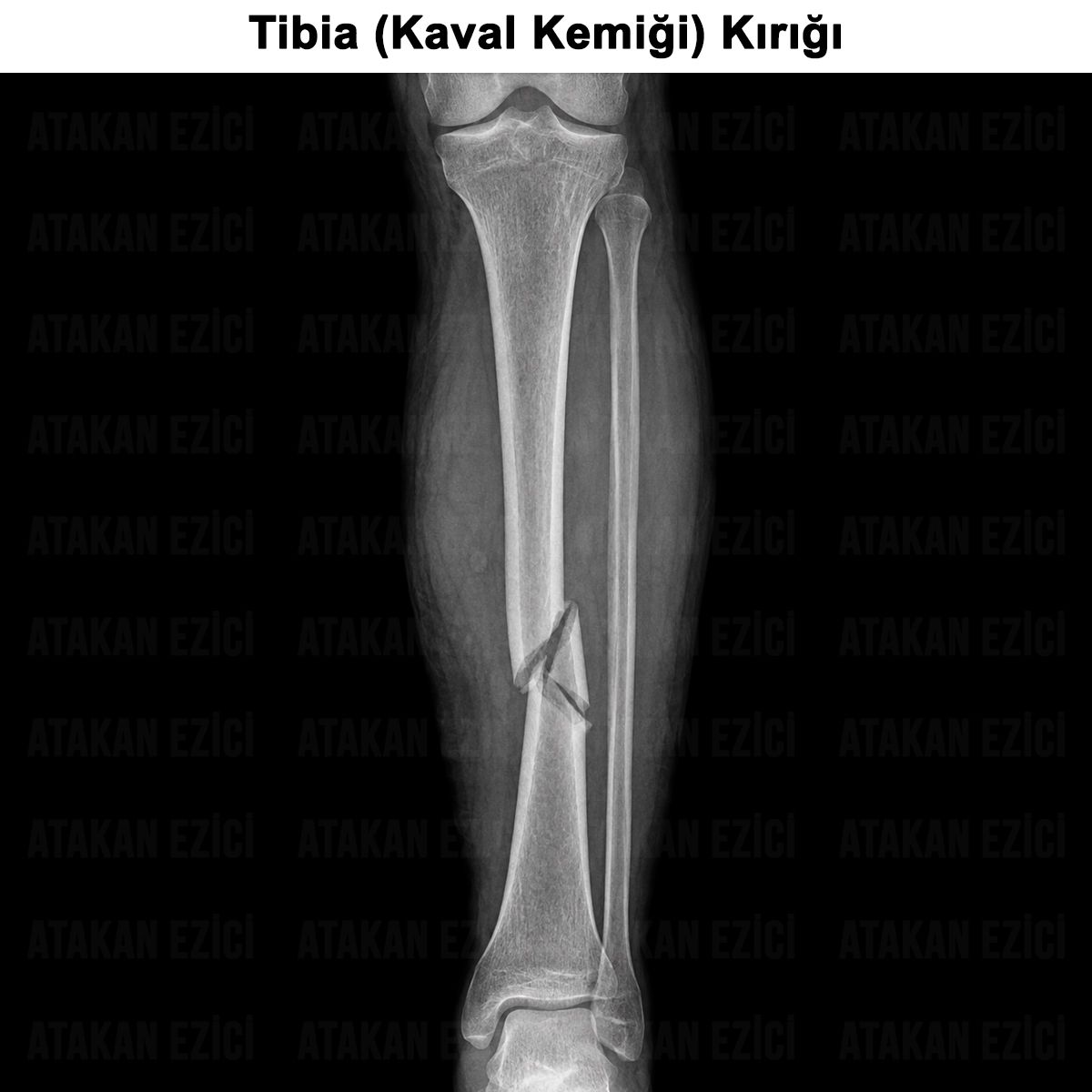 Tibia (Kaval Kemiği) Kırığı