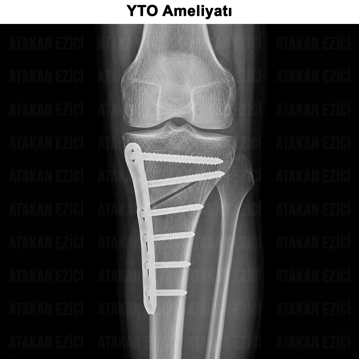 Yüksek Tibial Osteotomi (YTO) Ameliyatı: Nedir? Riskleri?